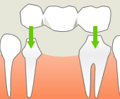保険の部分入れ歯または総入れ歯では、周辺組織に負担をかけたり、ガタついてうまく噛めなかったりします。