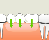 保険診療では、両側の健康な歯を削って土台にし、ブリッジを被せて欠損歯を補います。
